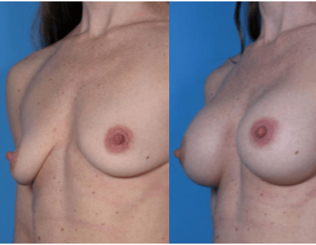 Breast Augmentation in DC